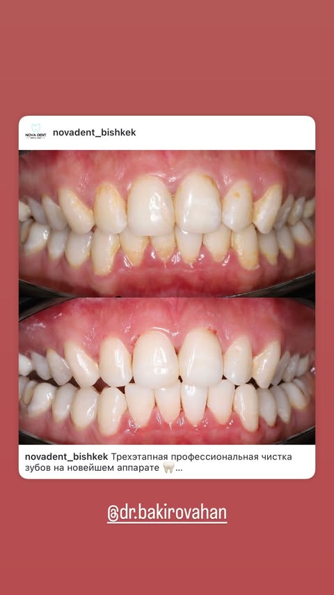 До/После: реставрация зубов