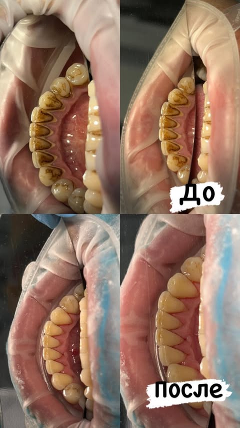 Имплантация