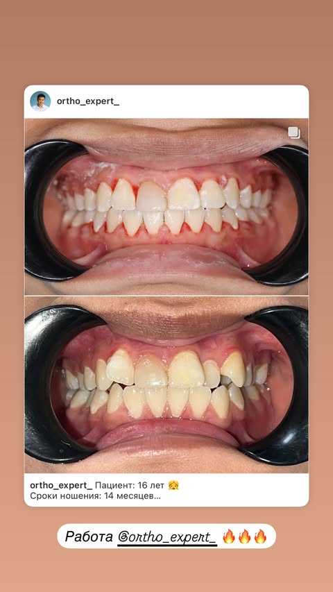 Лечение зубов