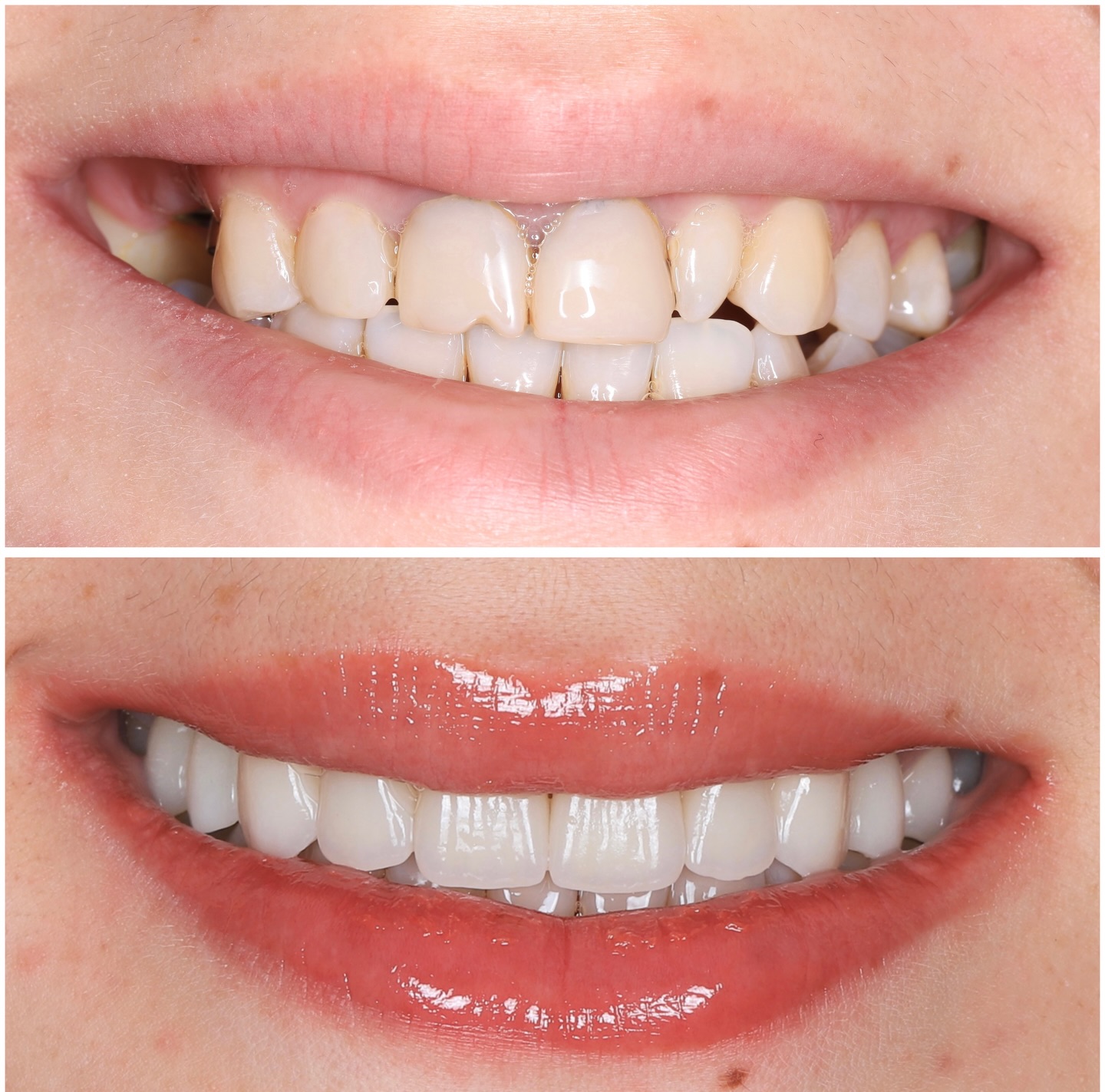 Результат работы — виниры